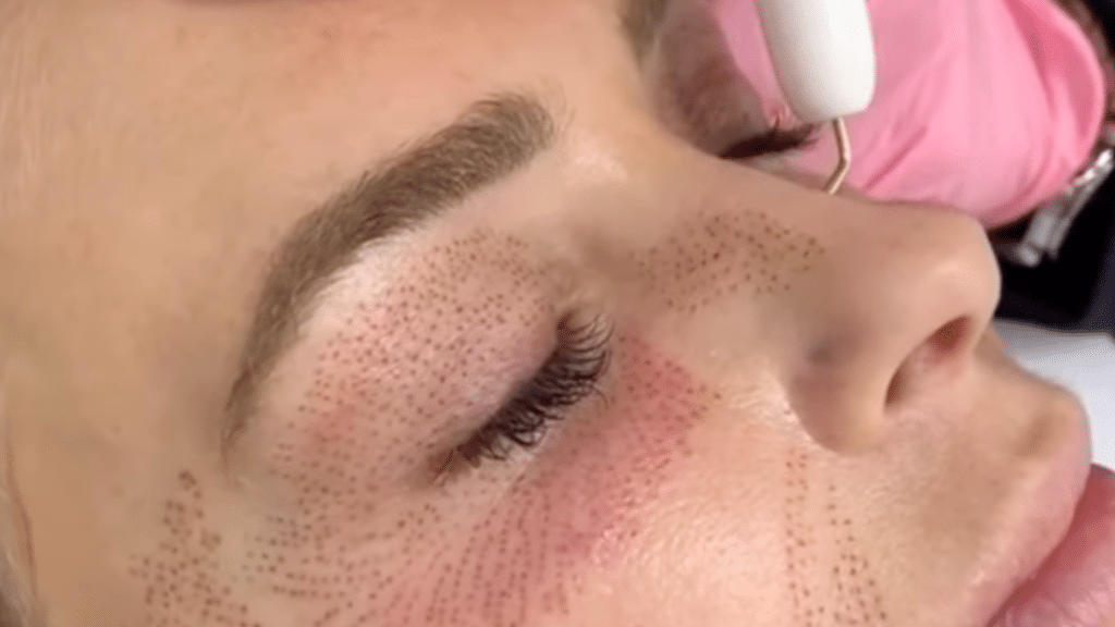 fibroblast skin tightening