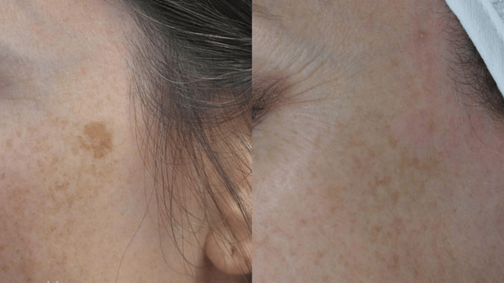 Laser Pigmentation Treatment
