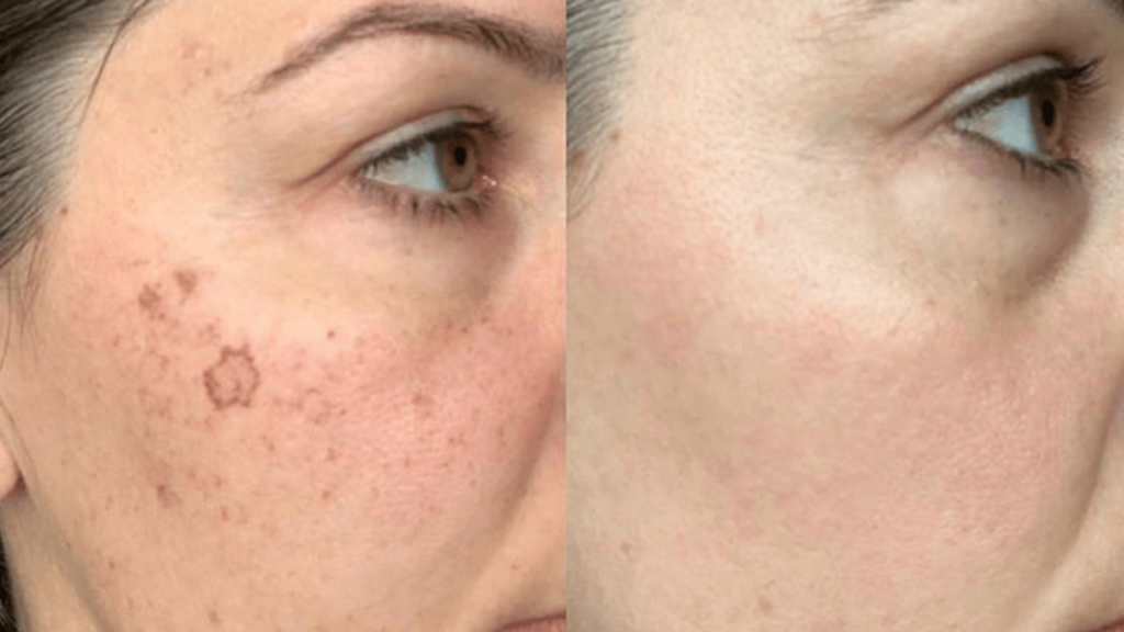 Laser pigmentation removal