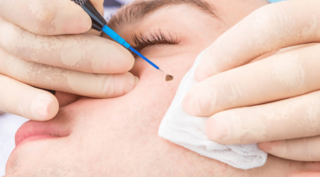 Radiofrequency and Electrosurgery