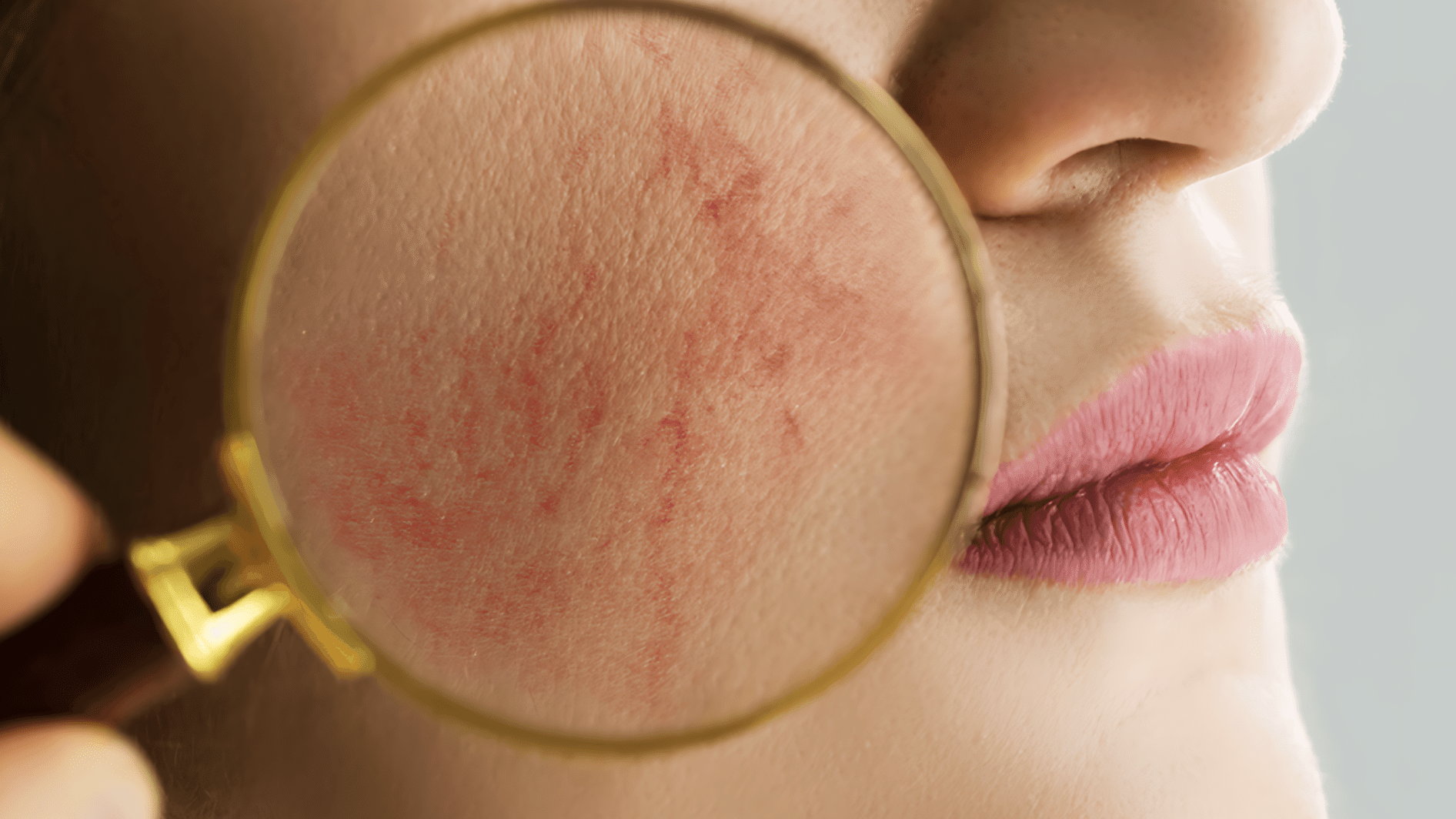 broken capillaries face