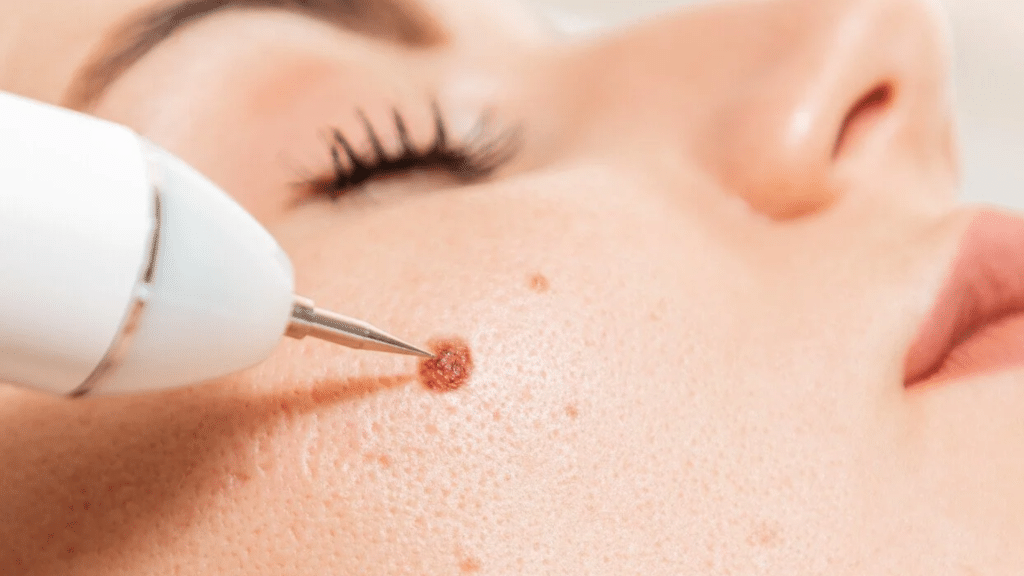 cryo-pen-removal