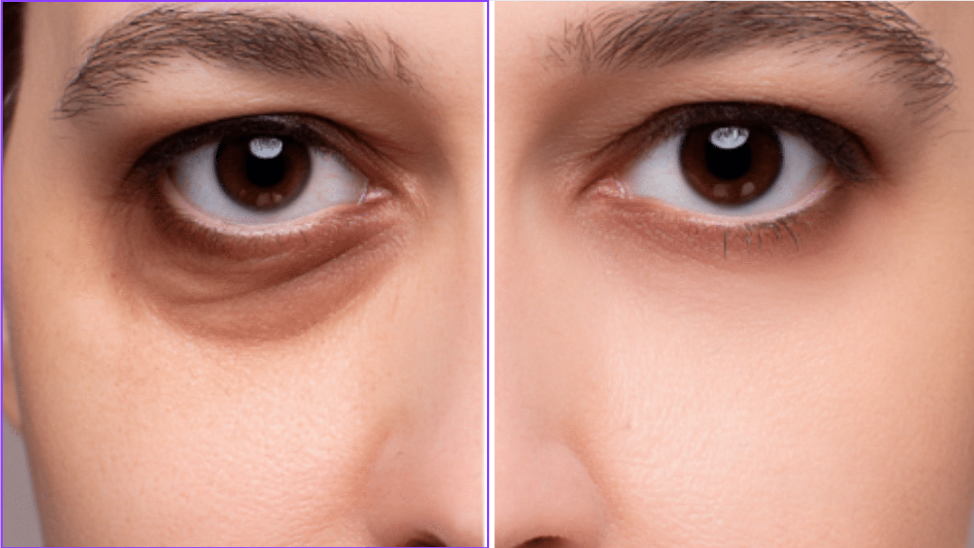 dark-under-eye-removal