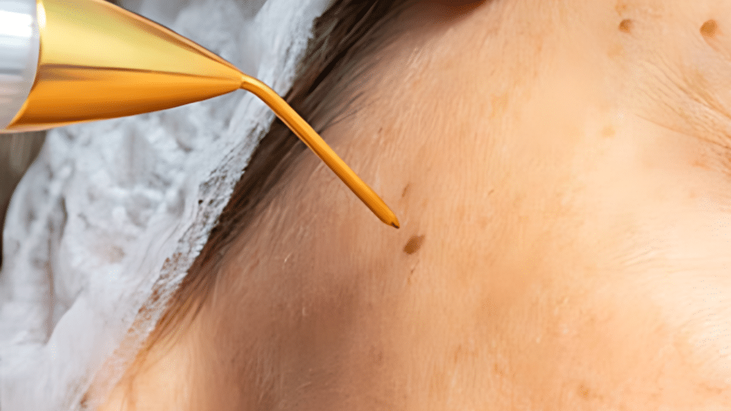laser-removal