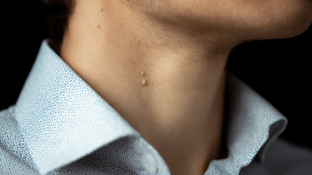Everyday causes of neck pimples