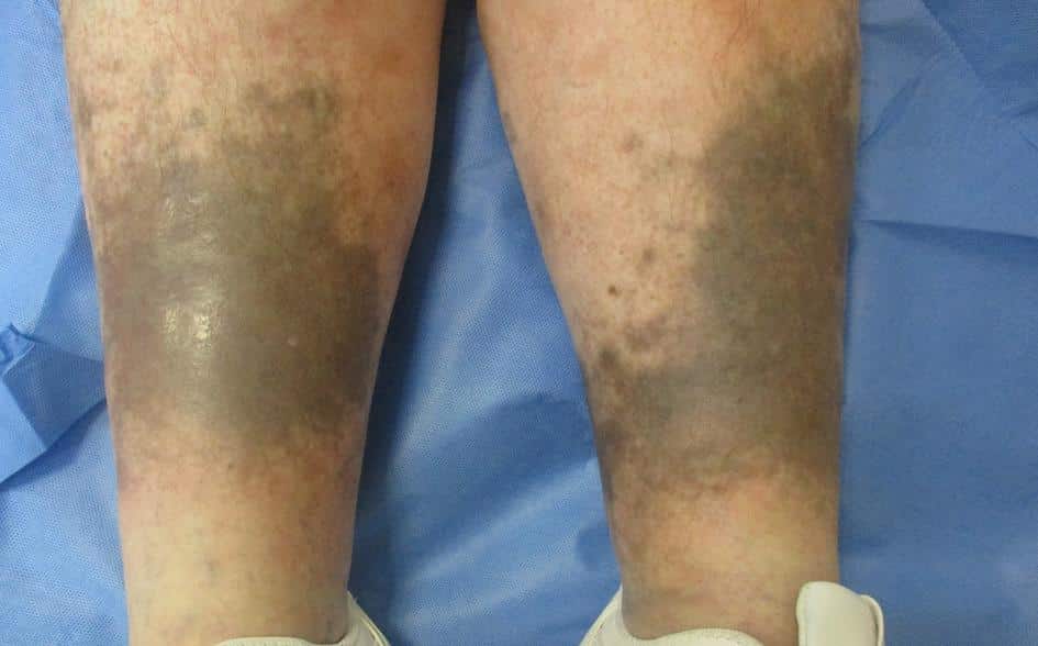 Post-Inflammatory Hyperpigmentation (PIH)