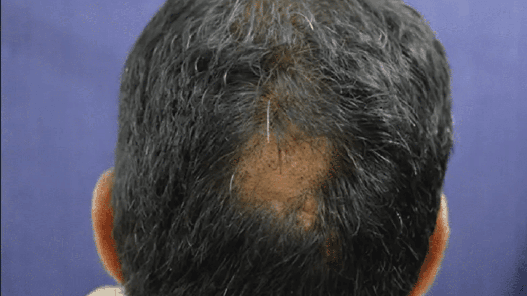 Does Anesthesia Cause Hair Loss