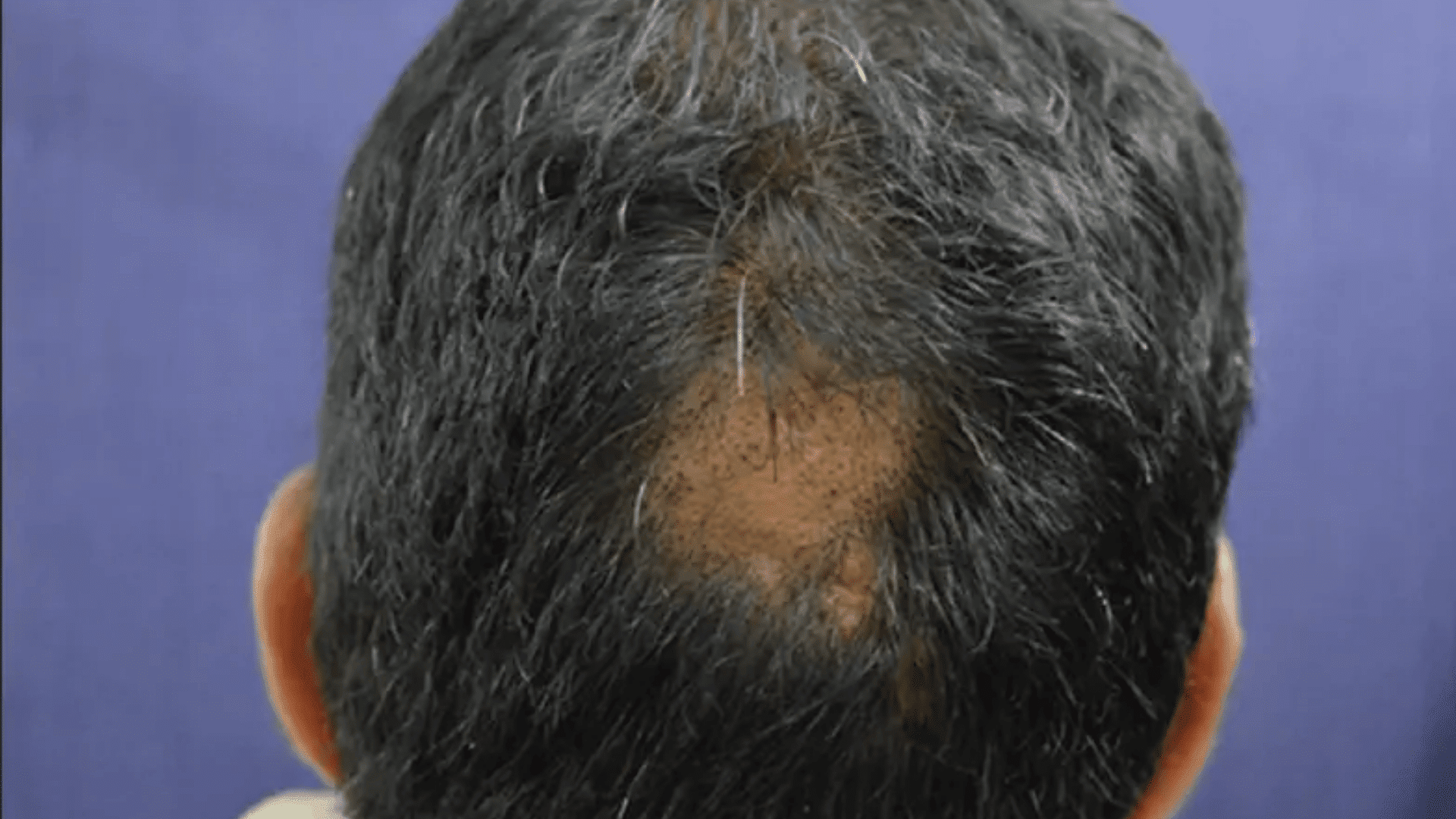 Does Anesthesia Cause Hair Loss