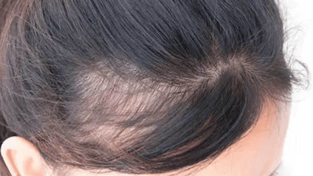 PCOS Hair Loss (1)