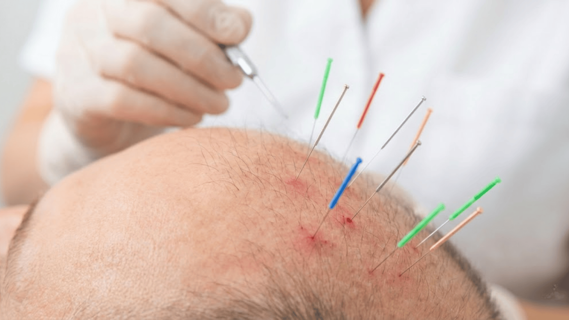acupuncture for hair loss