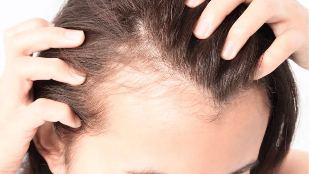 androgenetic pattern hair loss