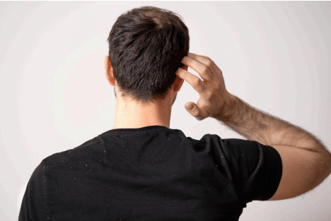 Dandruff Treatment: What Actually Works, What Fails & How Doctors Treat Persistent Dandruff