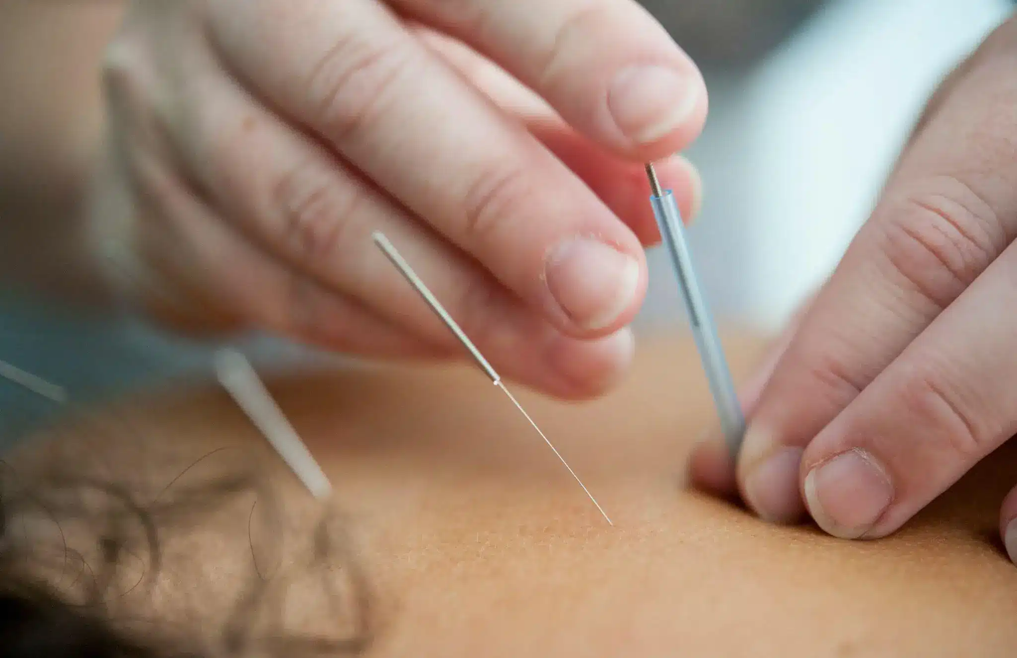 Acupuncture needles being inserted into skin by hands in close-up view