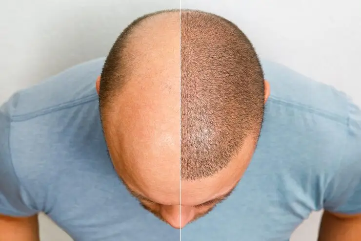 Man's head with side-by-side comparison of balding and fuller hair, wearing blue shirt