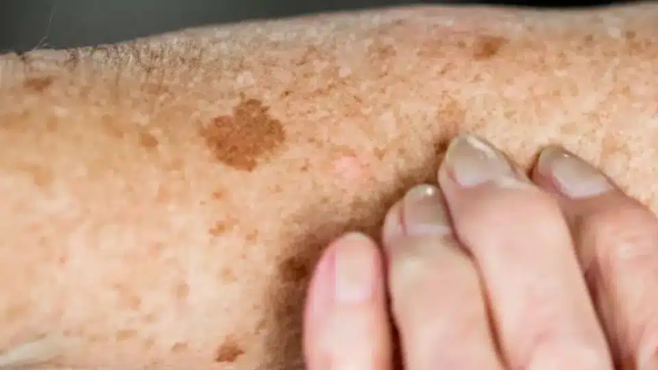 Pigmentation spots caused on skin due to aging