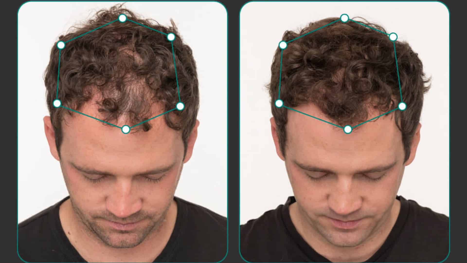 Before-and-after Nutrafol hair growth comparison showing improved hairline density in a man with curly hair after six months
