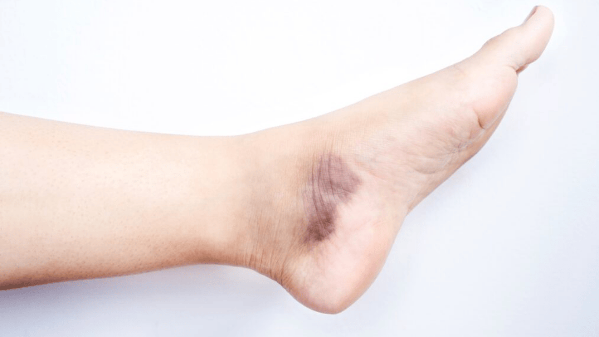 Dark bruise on the side of the foot due to stubbing