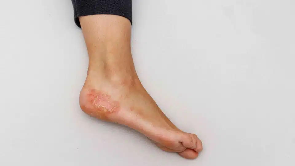 Red discoloration patch on foot due to chemical and allergic reactions