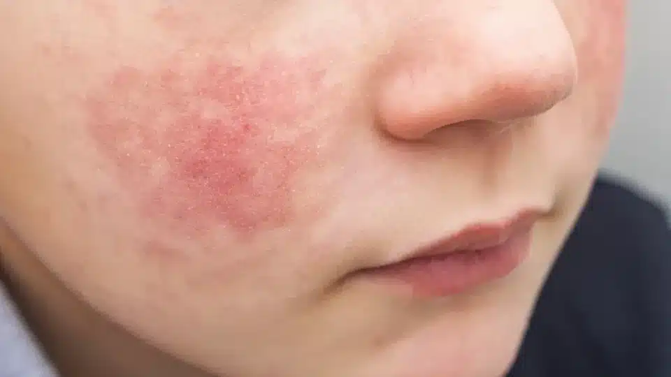 Child showing facial redness and dry irritated skin linked to eczema