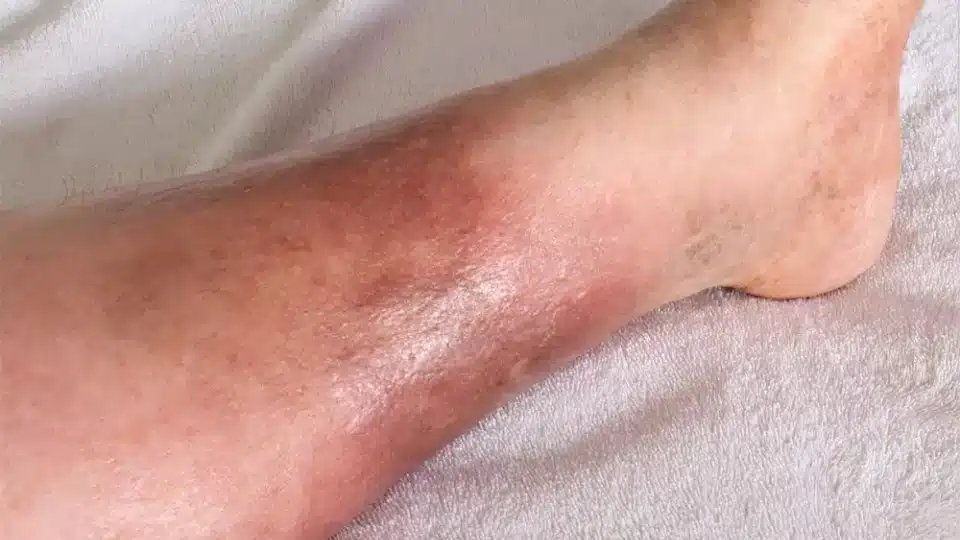 Bluish and purplish spots on leg caused due to conditions like diabetes that affect blood flow
