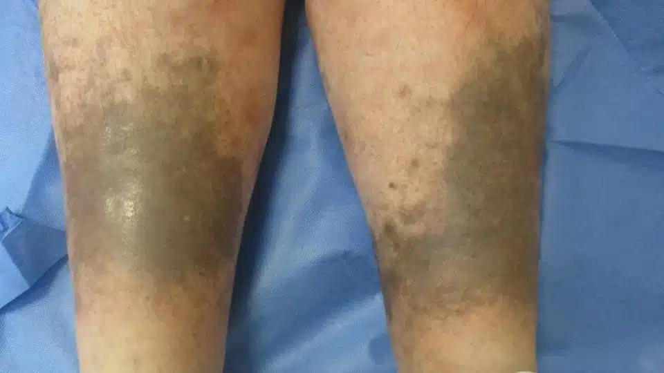 Post-Inflammatory Hyperpigmentation on legs due to excess melanin production in skin