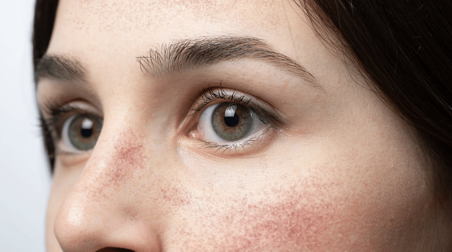 Woman with rosacea showing persistent facial redness across cheeks and nose with visible skin irritation and flushing