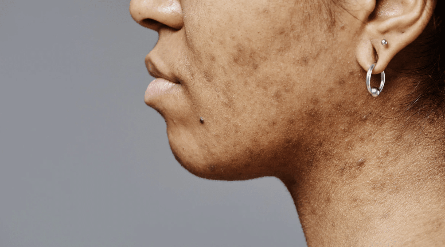 Woman showing post acne inflammation with marks and uneven skin tone after breakouts on face