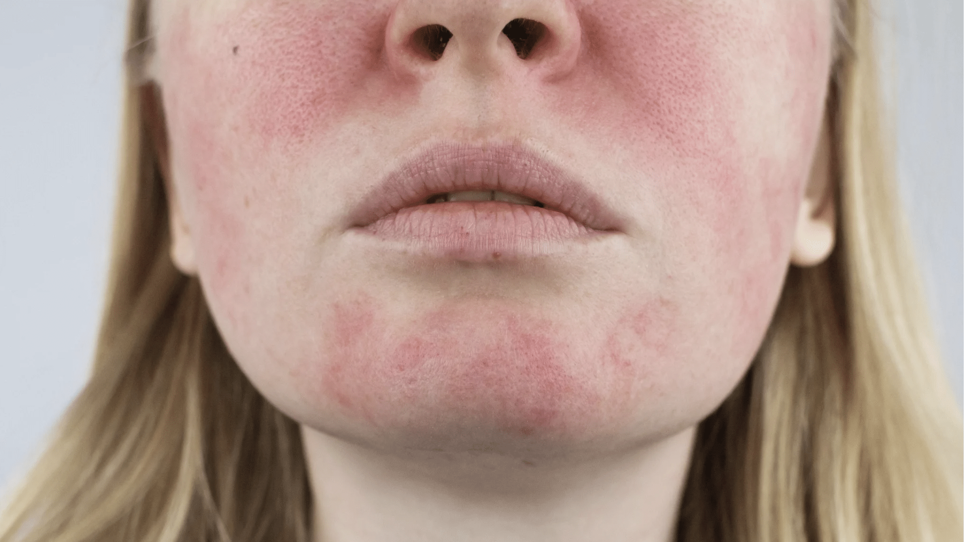Woman with sensitive skin showing facial redness and irritation on cheeks