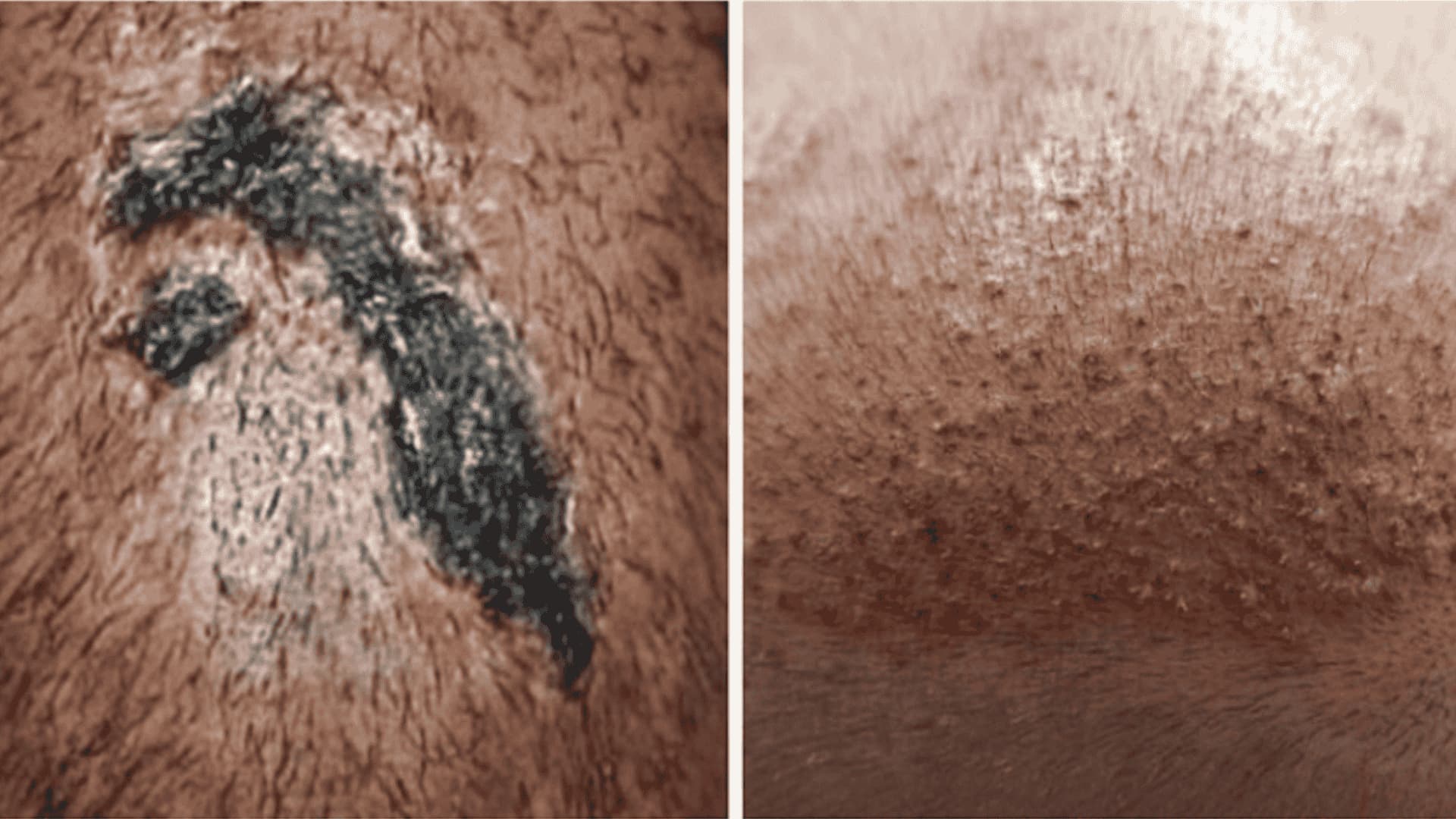 Signs of Infection from Hair transplant