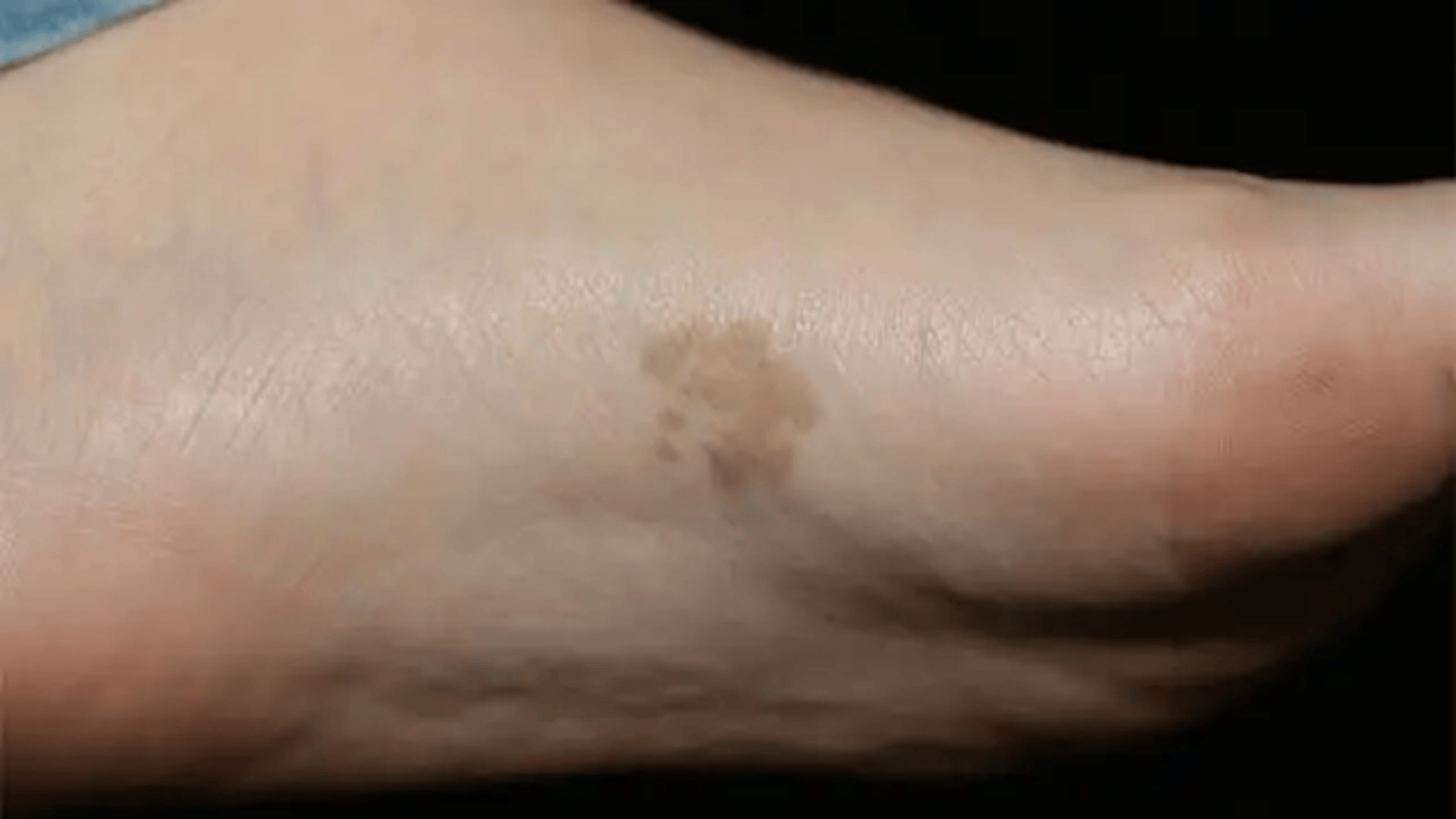 brown patch on the sole of due to Tinea Nigra fungal infection