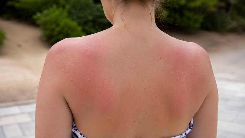 Are Blisters From Sunburn Serious Find Out Now