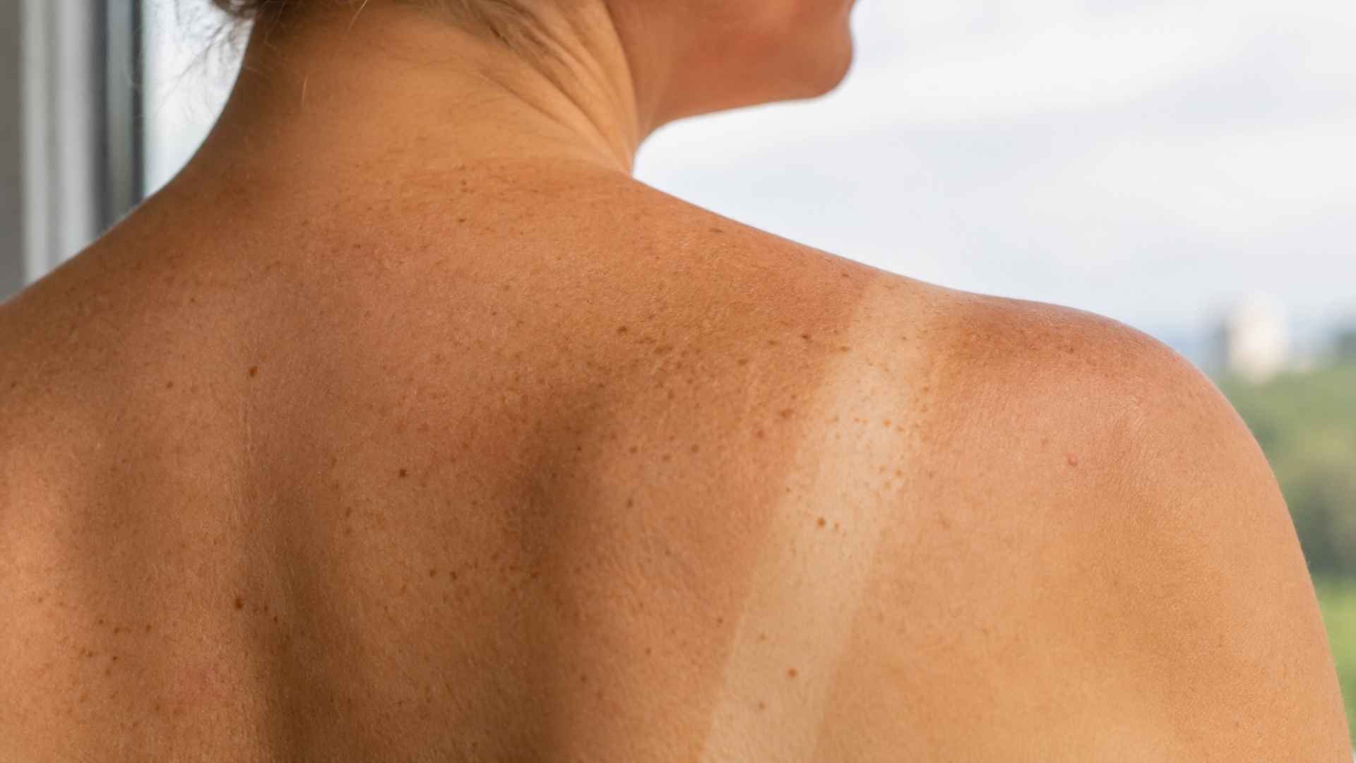 Close up shoulder showing freckles and sun exposure marks after a faded sunburn with lasting skin damage signs