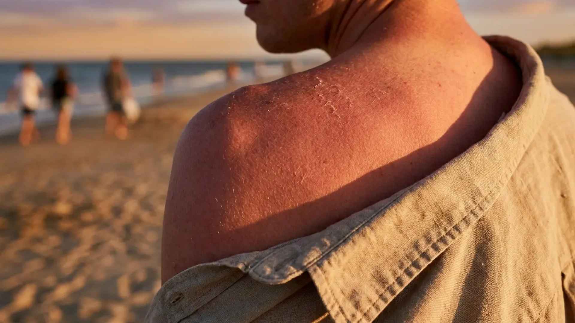 Sunburned shoulder skin showing redness and irritation after prolonged sun exposure outdoors