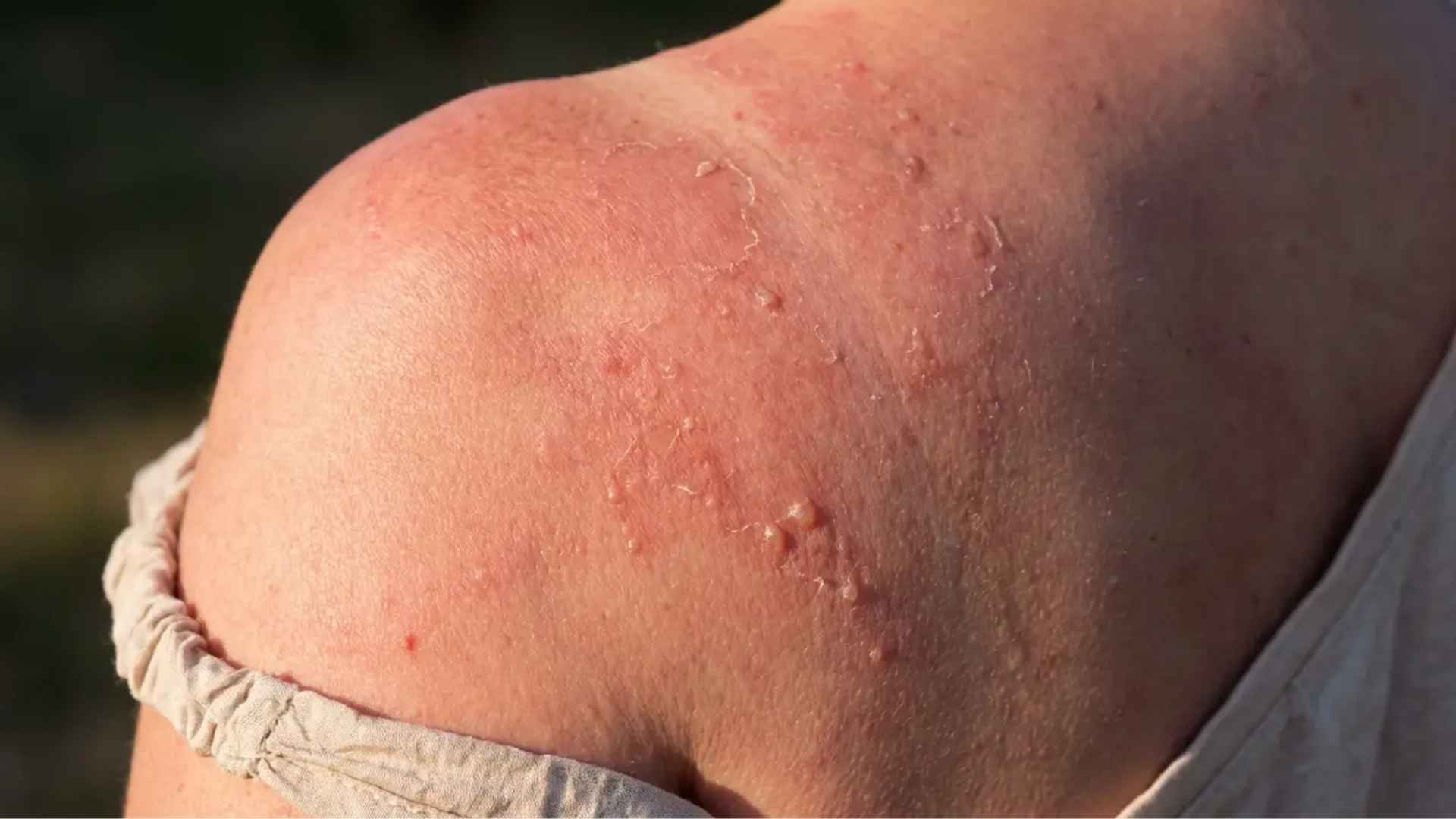 Close-up of red sunburned shoulder with peeling skin showing irritation after sun exposure and healing process