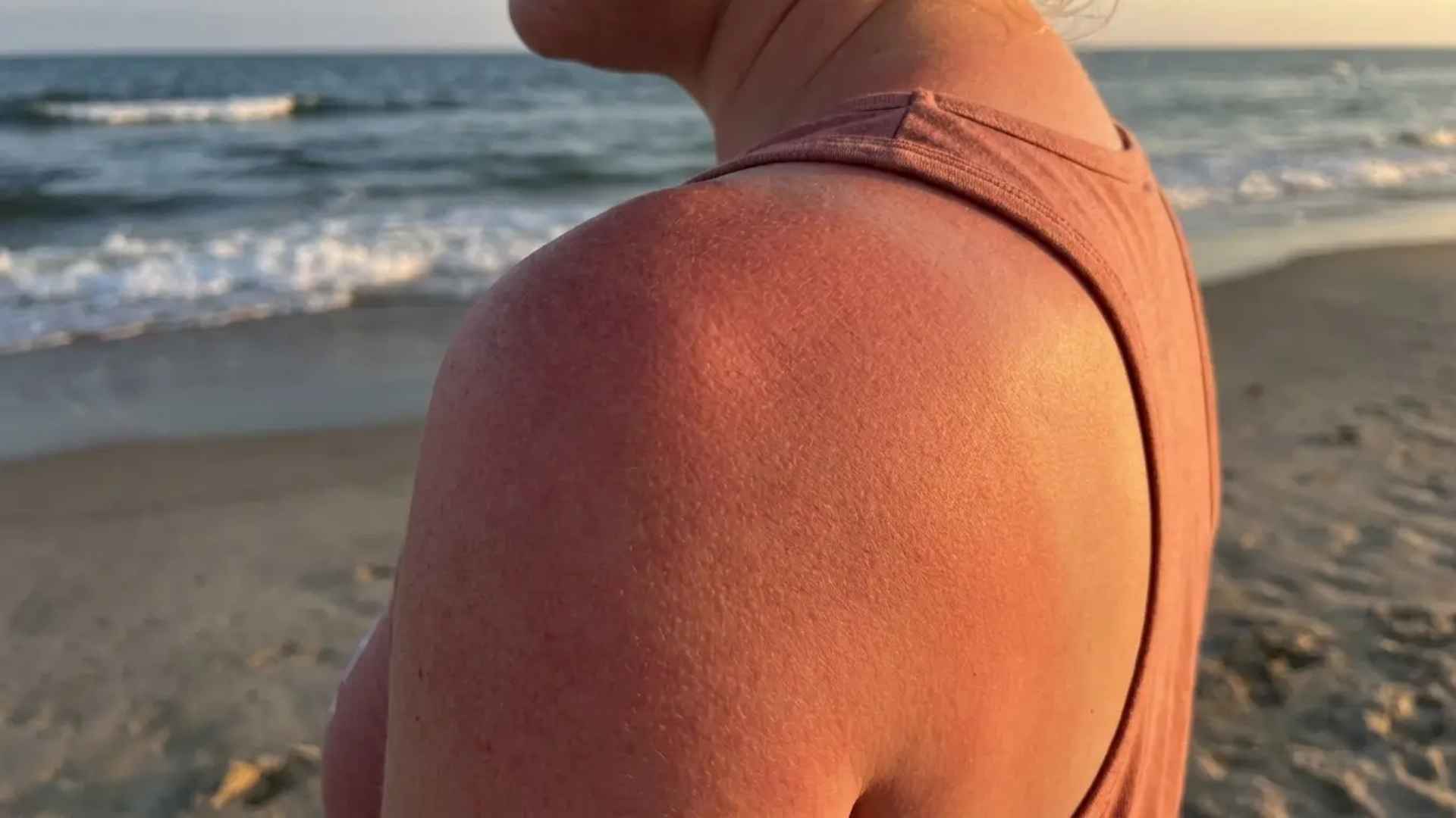 Sunburn Really Takes to Fully Heal