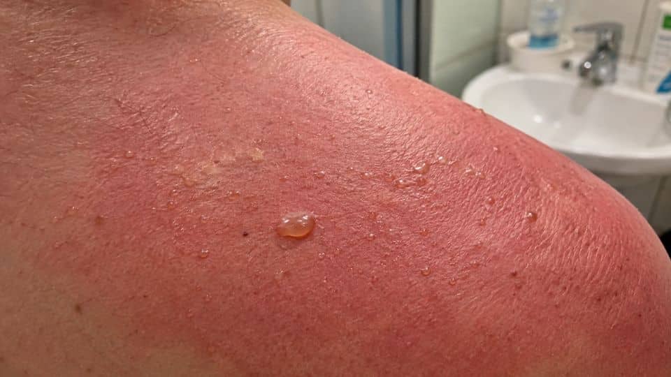 Close-up view of sunburned shoulder skin with small fluid-filled blisters and redness from severe sun exposure