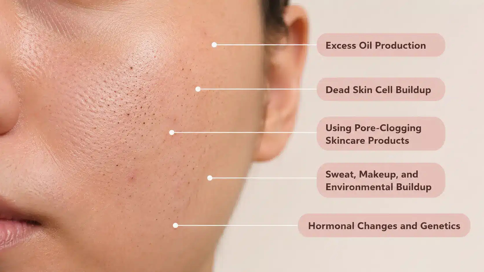 list of causes that lead to occurence of blackheads on cheeks
