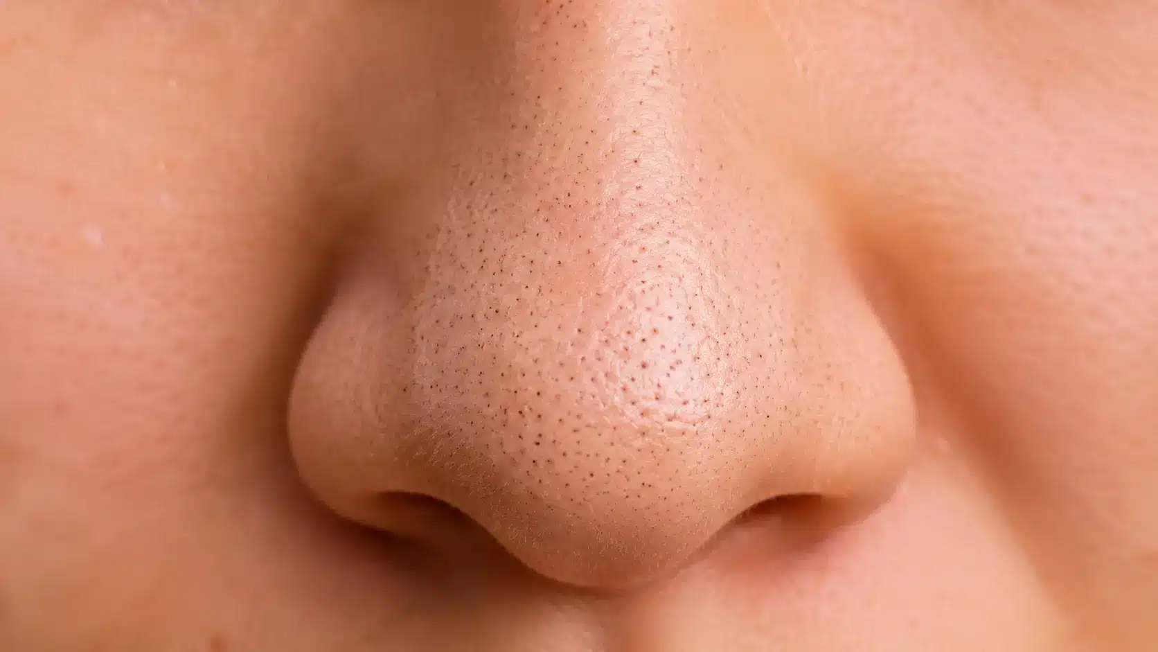 Close up view of visible blackheads and enlarged pores across the nose showing natural skin texture in clear detail