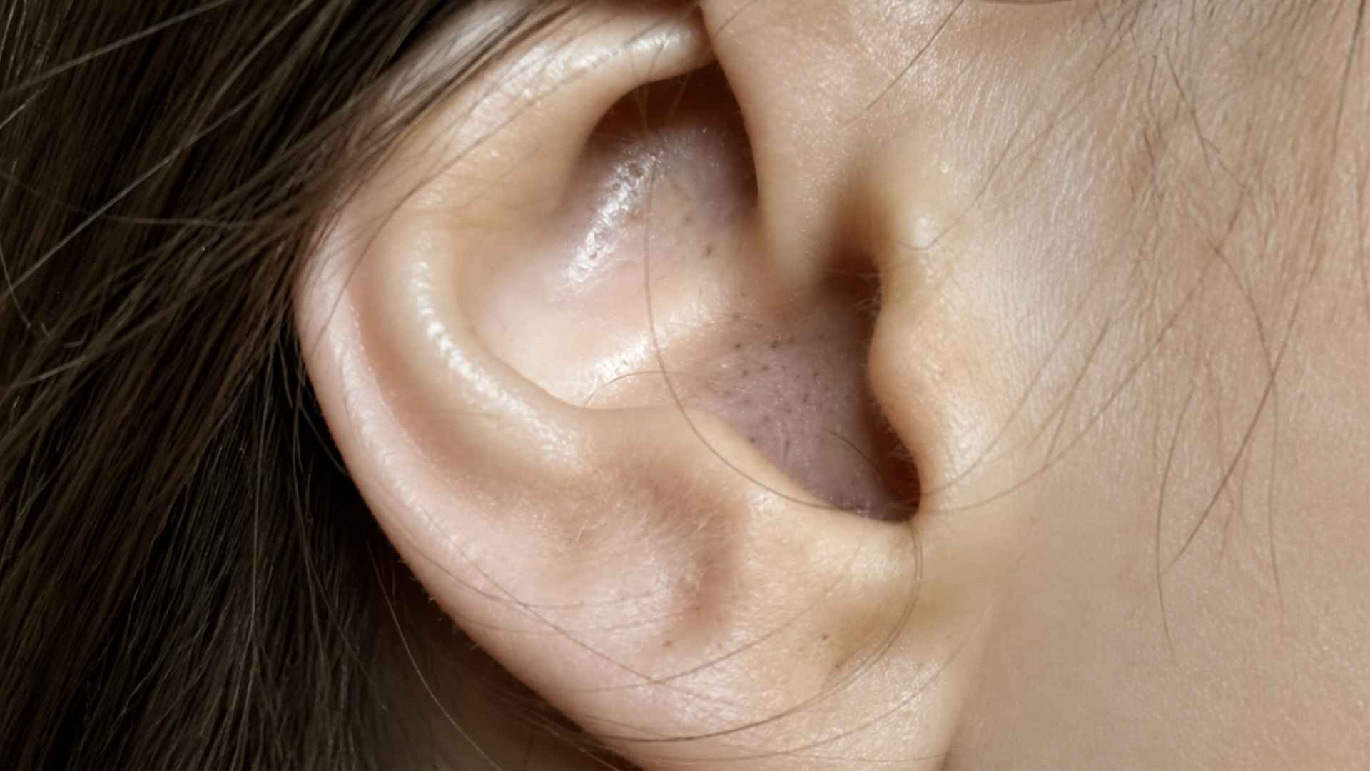 Close view of an ear with several dark clogged pores and blackheads visible along the earlobe and adjacent facial skin