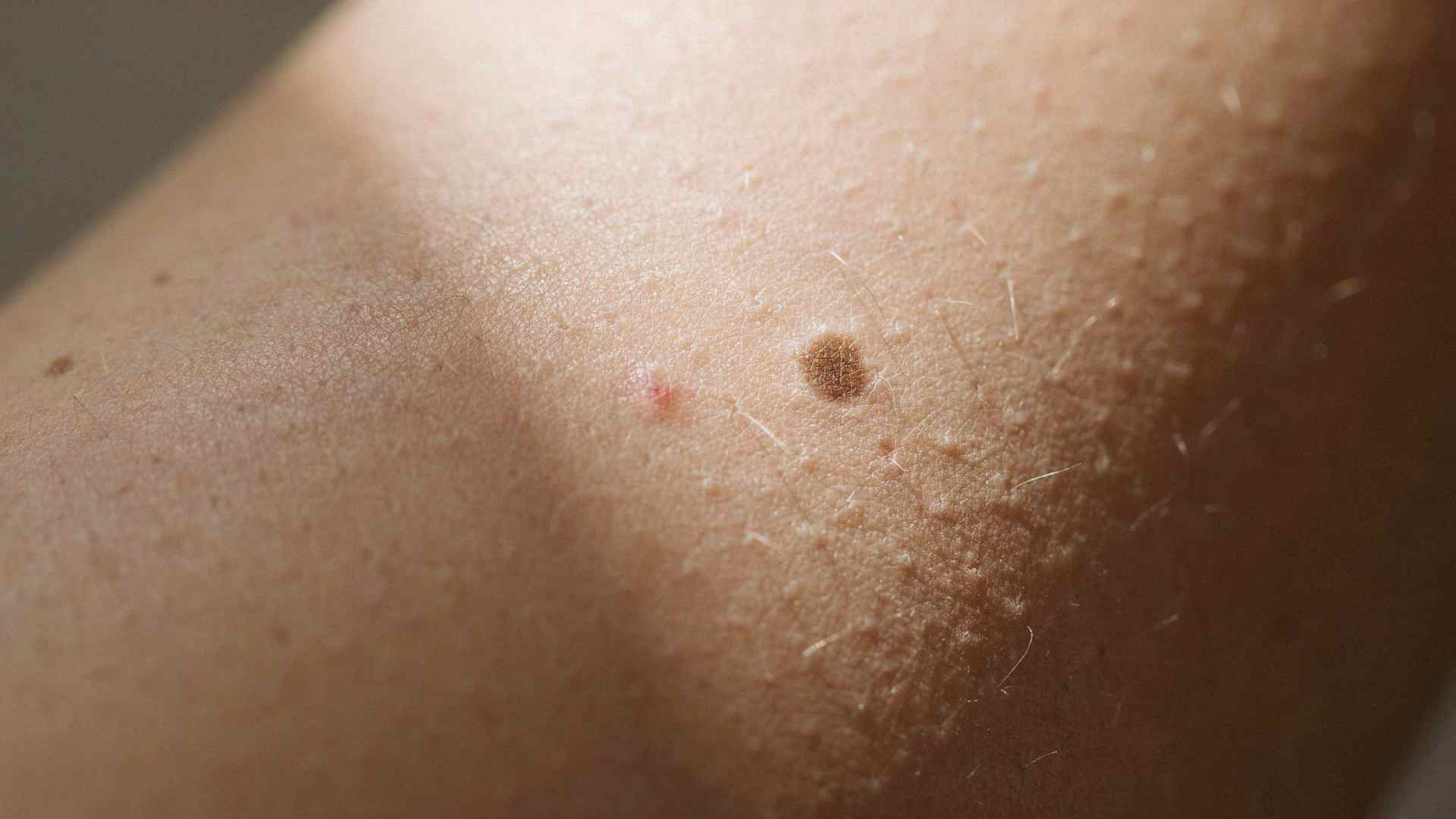 Close up of skin texture showing a naturally forming pigmented mole